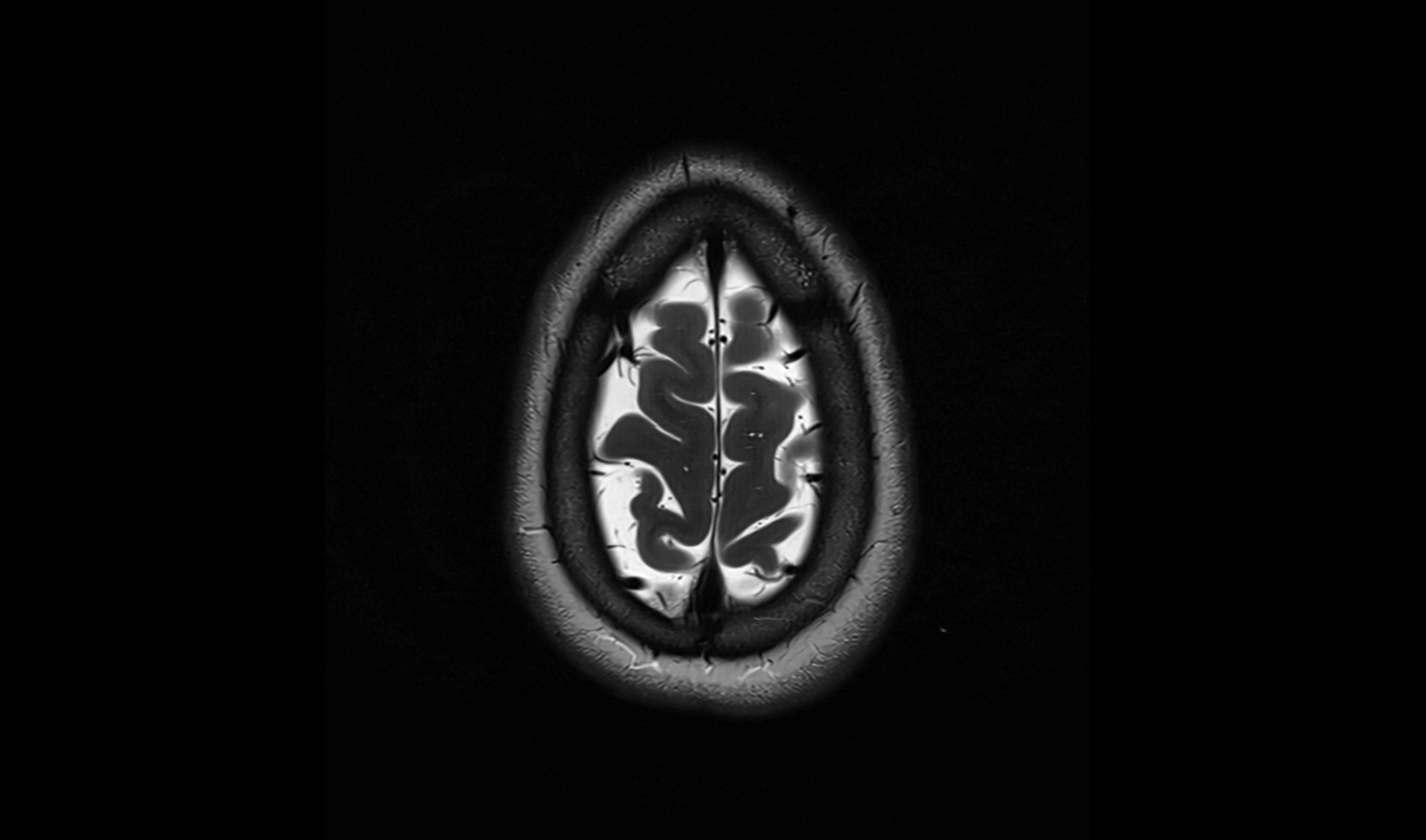 Brain cisterns  and ventricles  axial anatomy 3T MRI image-img-00001-00054.webp